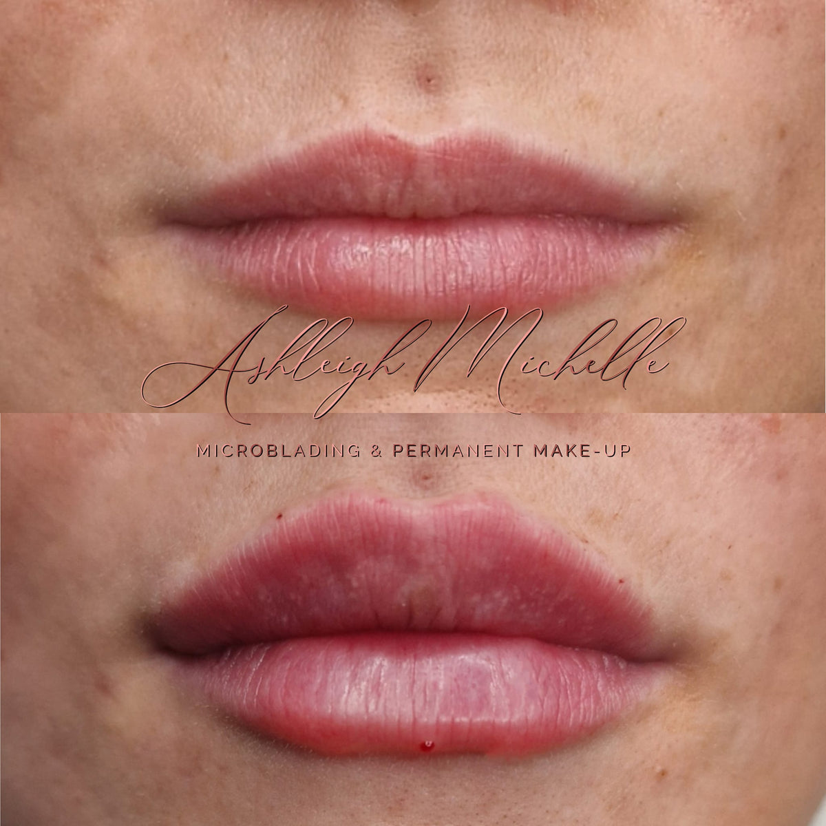 Natural Fillers, Russian Lips