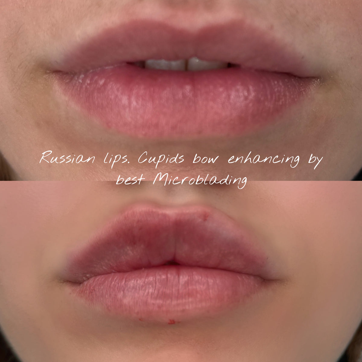 Natural Fillers, Russian Lips