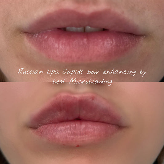 Natural Fillers, Russian Lips